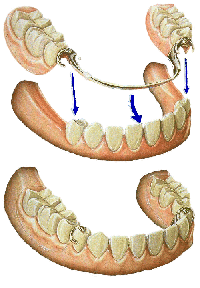partual denture